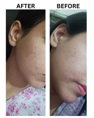 Zenova Acne Face Cleanser